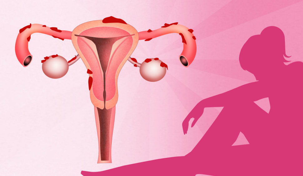 Endometrióza
