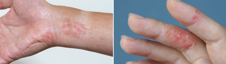 Jak se zbavit ekzému? Vyzkoušejte naše 4 ověřené kroky