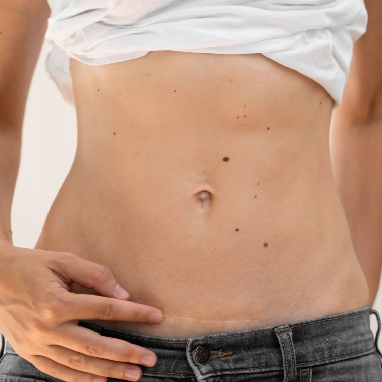 žena s jizvou po císařském řezu