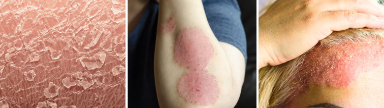 Jak vypadá ekzém? Poznejte ho a reagujte včas!