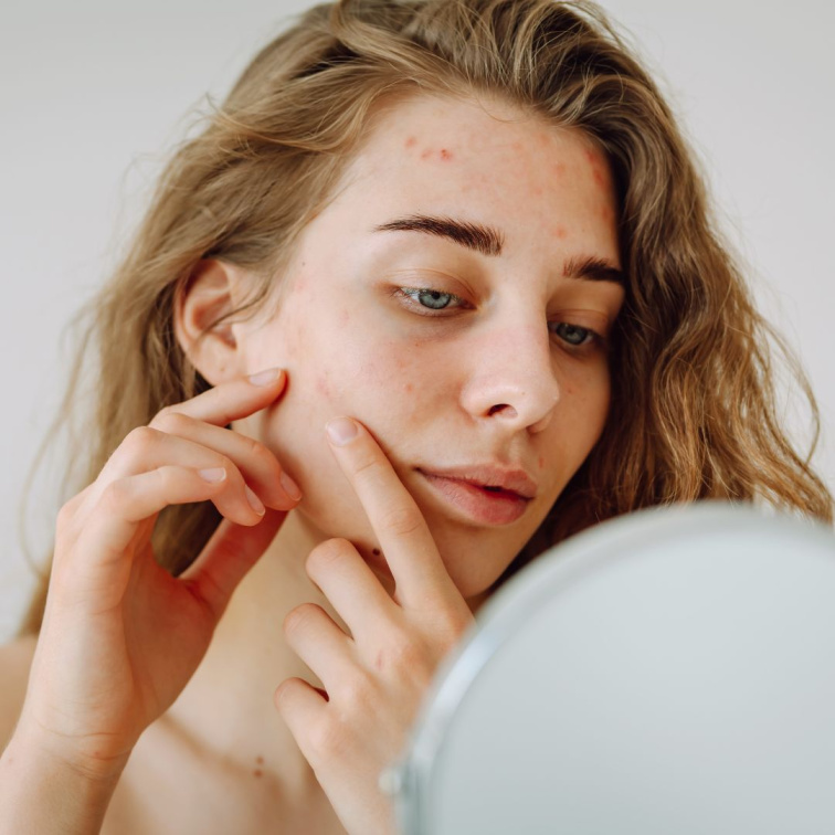 Mladá žena s akné na čele se prohlíží v zrcadle a řeší péči o problematickou pleť s přírodní kosmetikou