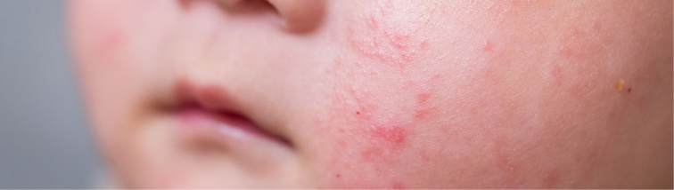 Jak vypadá ekzém? Poznejte ho a reagujte včas!