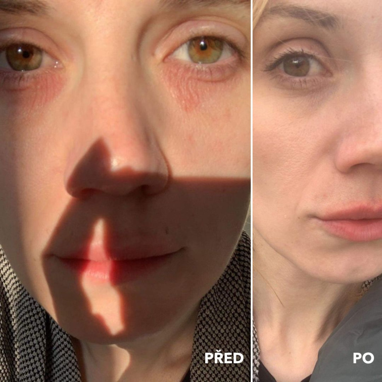 žena trpící ekzémem kolem očních víček před a po použití kosmetiky Anela