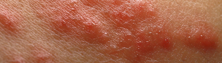 Jak vypadá ekzém? Poznejte ho a reagujte včas!