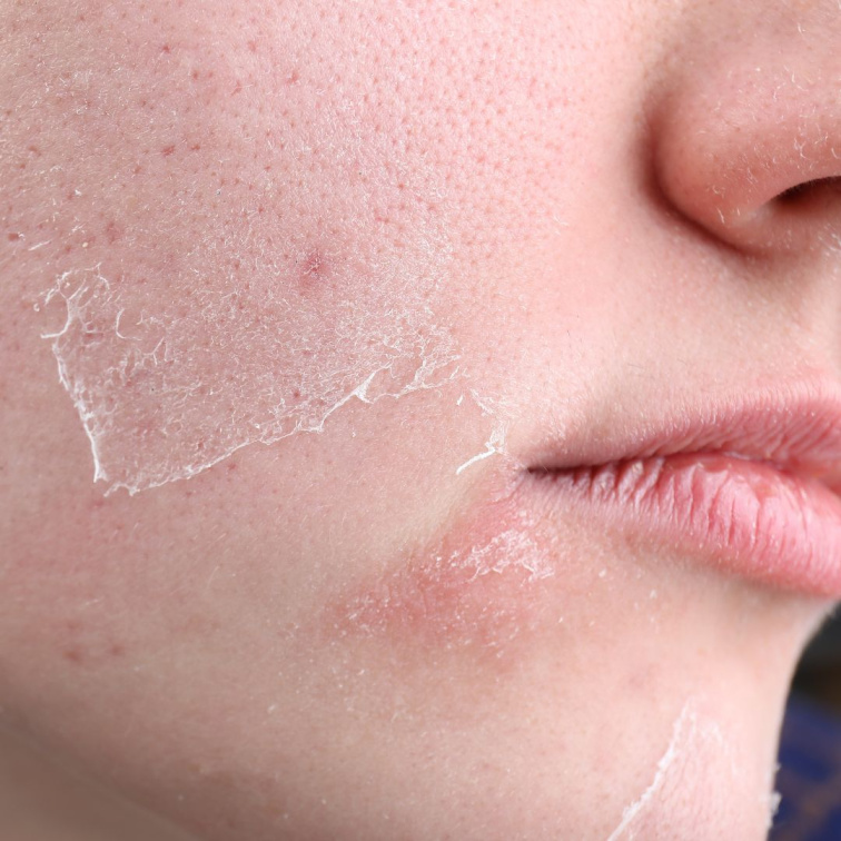 pleť s poškozenou kožní bariérou