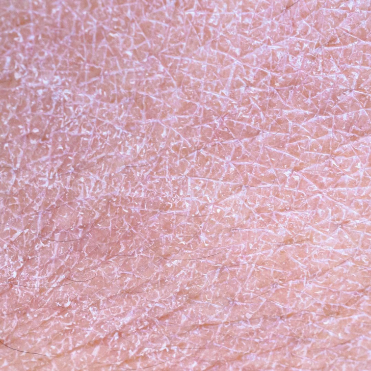 dehydratovaná pleť