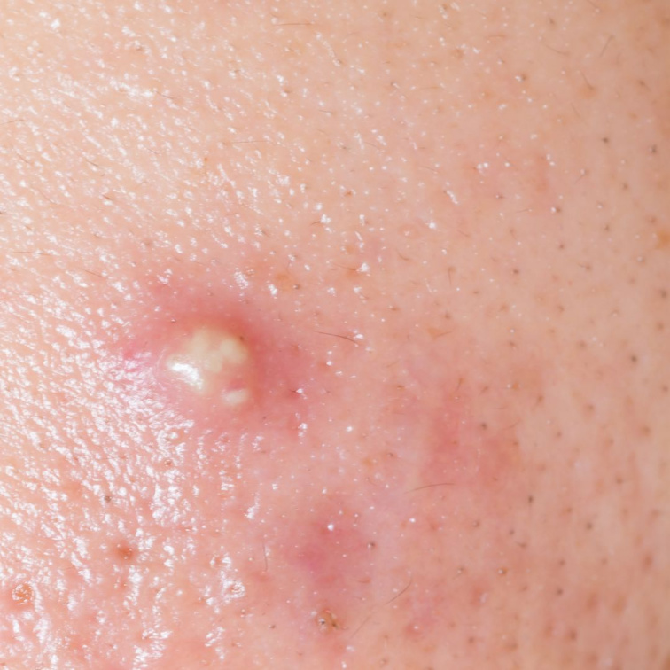 mastná pleť se sklonem k akné