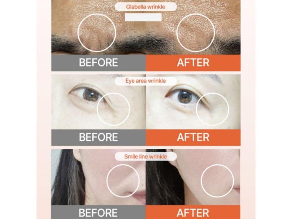 ACROPASS - RETINOL RETI-RN MICROCONE PATCH T SHAPED - Mikrojehličková anti-age náplast s retinolem a PDRN pro cílenou péči o hlubší vrásky glabella 4 ks