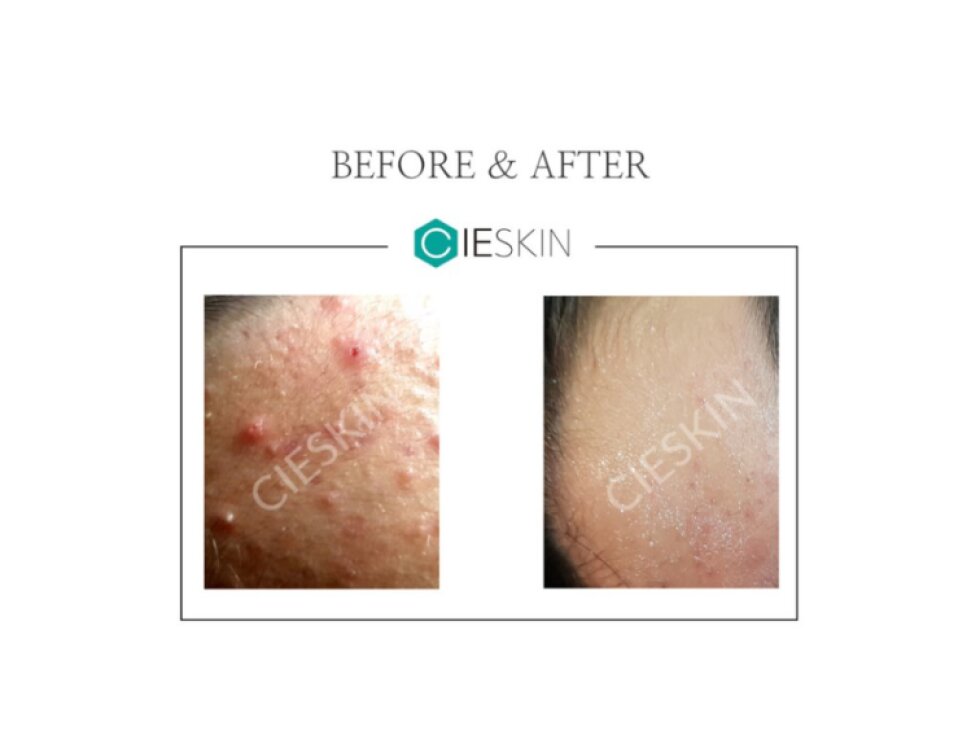 CIESKIN - DERMA G SPICULE ESSENCE - Pleťová esence s aktivními mikrojehličkami 30 ml