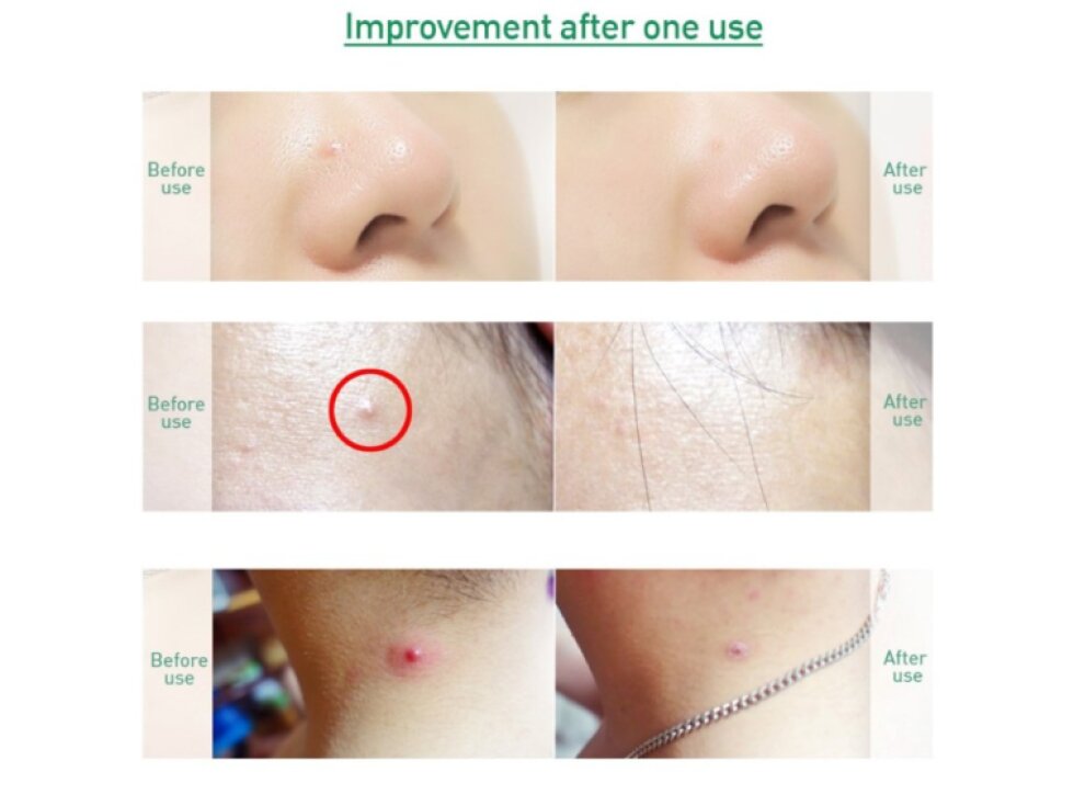 ACROPASS - TROUBLE CURE SET - Lokální sada na akné s mikrojehličkovými náplastmi a čisticí péčí 6 ks