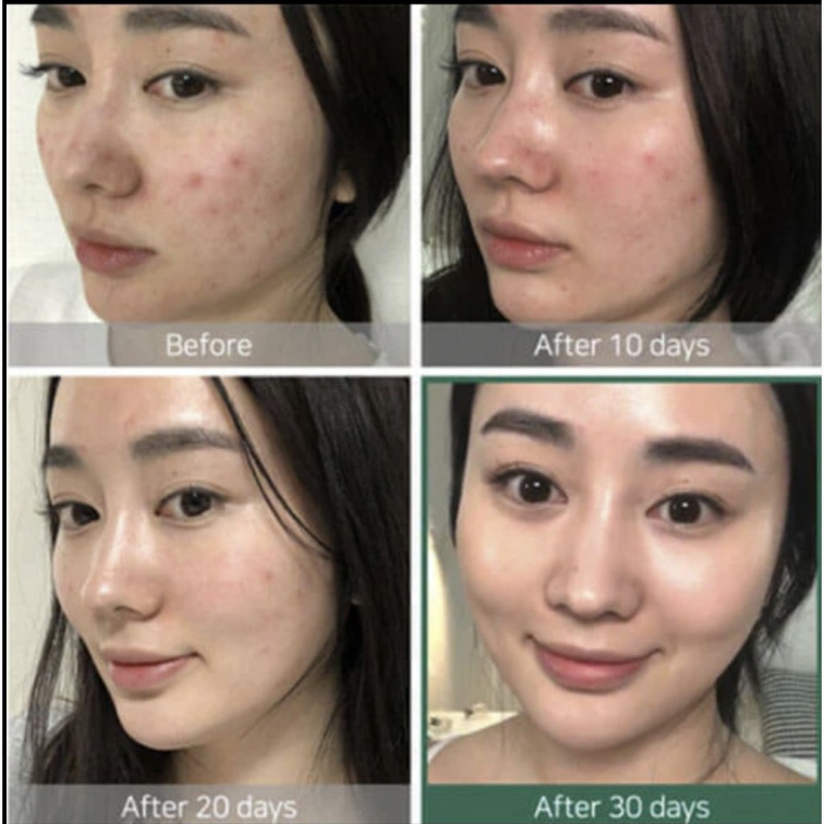 SOME BY MI – AHA-BHA-PHA 30 Days Miracle Cream – Zklidňující pleťový krém proti akné s kyselinami 60 g