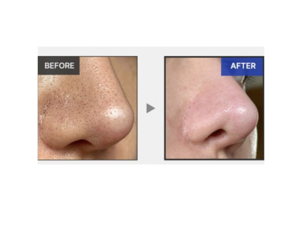 MEDICUBE - ONE DAY EXOSOME SHOT PORE AMPOULE 2000 MILD - Jemná exfoliační ampule pro čištění pórů a hladší pleť 30 ml