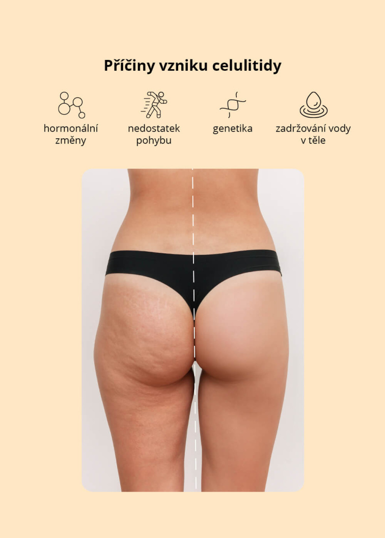 VENIRA vakuová baňka na celulitidu