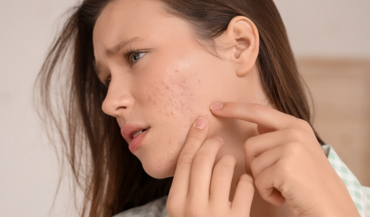 Akné na bradě a čelisti: co často znamená a proč se vrací pořád dokola
