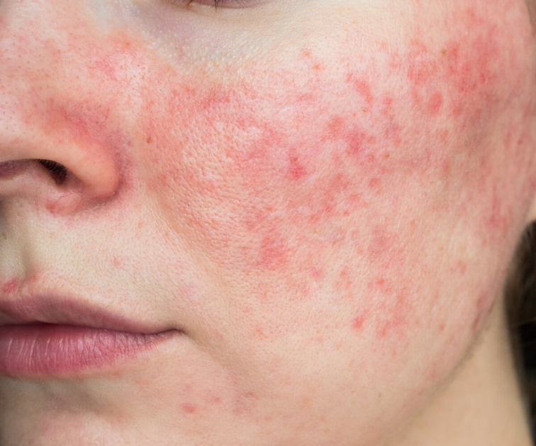 Rosacea a kuperóza: Co to je a jak pracovat s takto citlivou pletí?