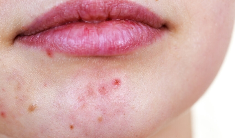 Akné na bradě a čelisti: co často znamená a proč se vrací pořád dokola