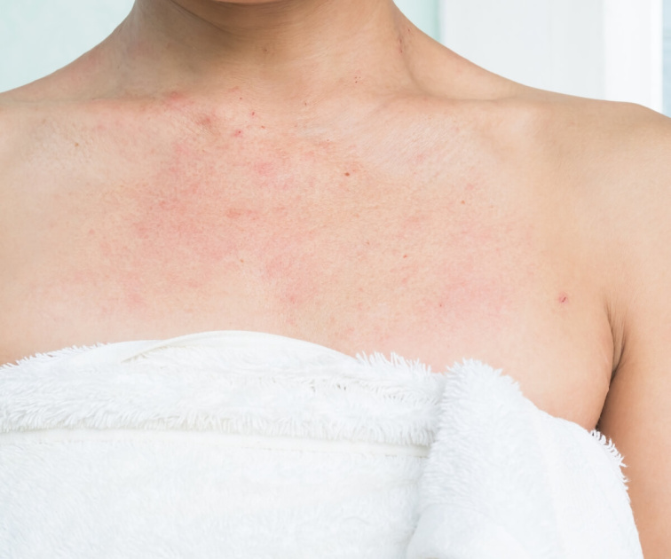 Atopický ekzém: Vše, co potřebuješ vědět