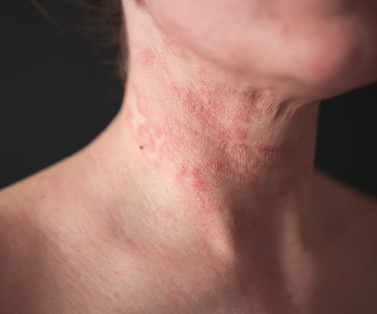 Atopický ekzém: Vše, co potřebuješ vědět