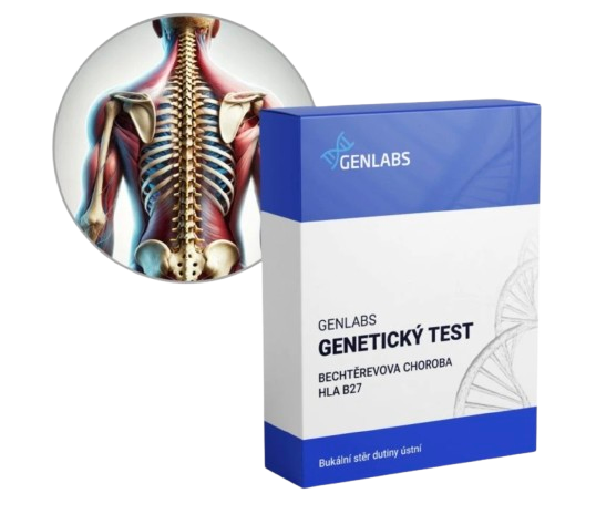 1x Bechtěrevova choroba (HLA B27)