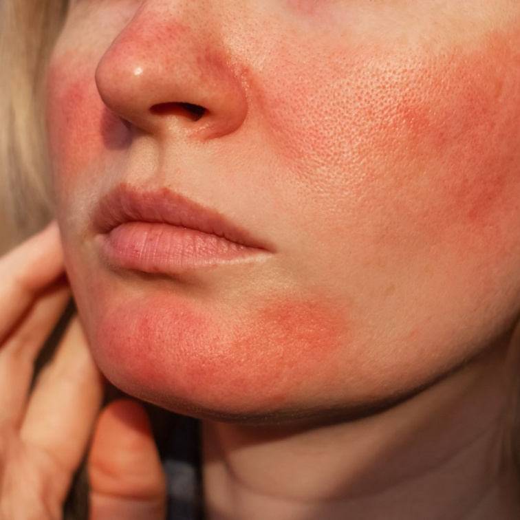 Rosacea - co mohu udělat pro zlepšení příznaků?