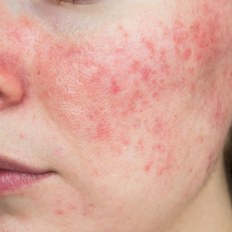 Rosacea - co mohu udělat pro zlepšení příznaků?