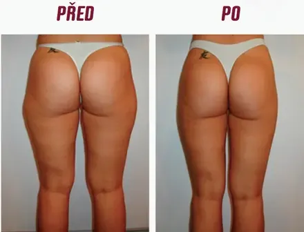 Celotělová přístrojová lymfatická masáž