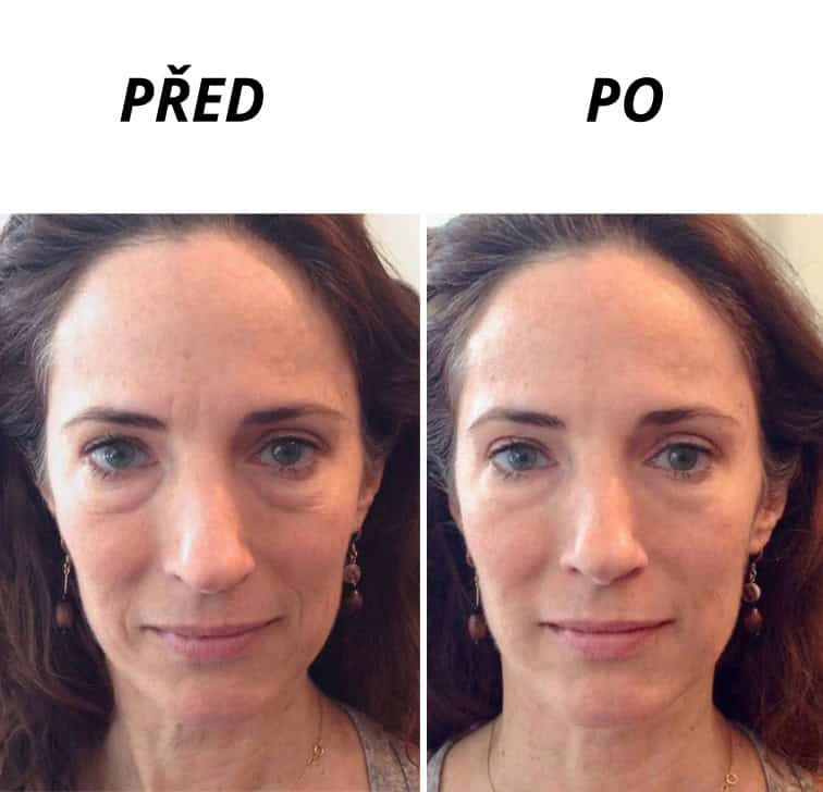 Kosmetické ošetření pleti PROFI CARE