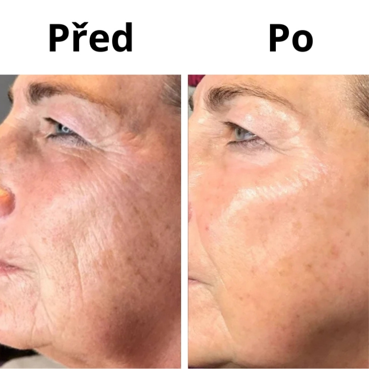 Mikrojehličková Mezoterapie