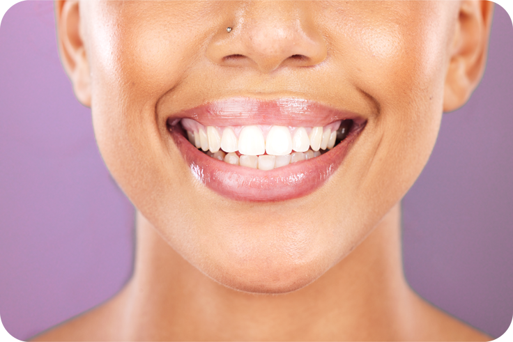 Vše, co potřebujete vědět o V34 technologii: Jak funguje fialová korekce zubů?