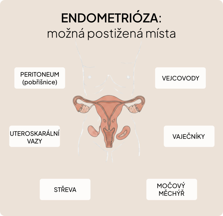 3měsíční Plán Dopřávám si to nejlepší – Endometrióza