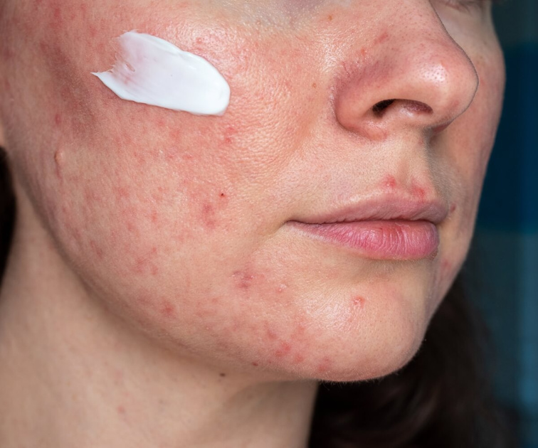 Rosacea a kuperóza: Čo to je a ako pracovať s takto citlivou pleťou?